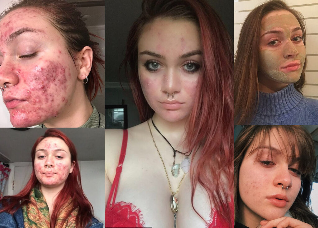 Young Woman Shares Her Journey with Severe Acne and the Treatment That Changed Her Life