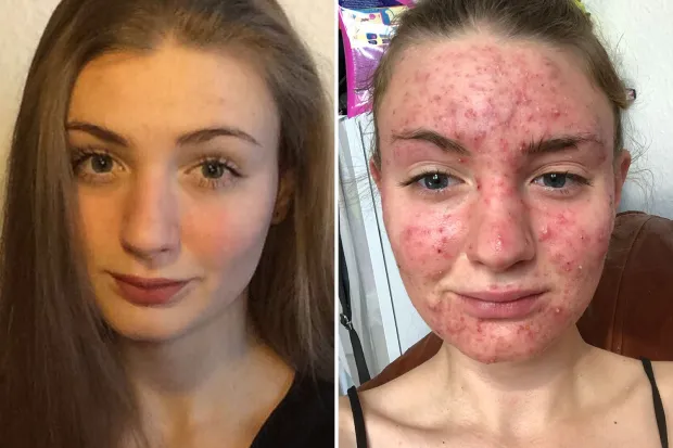 I’d never had a spot but broke out with painful cystic acne after taking the pill – I couldn’t sleep & affected my sight